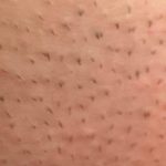 Ideale lengte haartjes tijdens behandeling