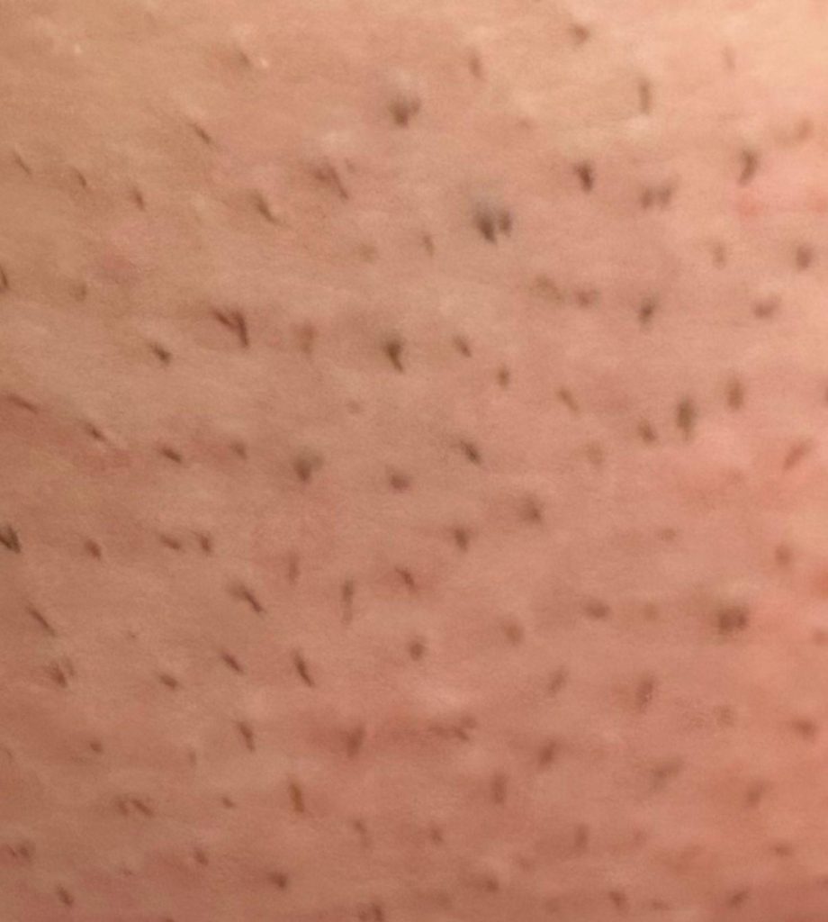 Ideale lengte haartjes tijdens behandeling